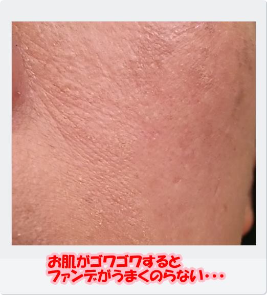 肌がゴワゴワして赤みがあり、かゆい。原因と改善法は? 超敏感肌40代主婦・みすずの化粧品スキンケア探しブログ 肌がゴワゴワして赤みがあり、かゆい。原因と改善法は? 超敏感肌40代主婦・みすずの化粧品スキンケア探しブログ