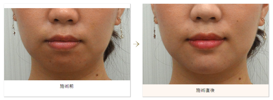 脂肪吸引 腫れない二重埋没 水の森美容外科科 名古屋院 大阪院 東京銀座院 北海道院 スタッフブログ