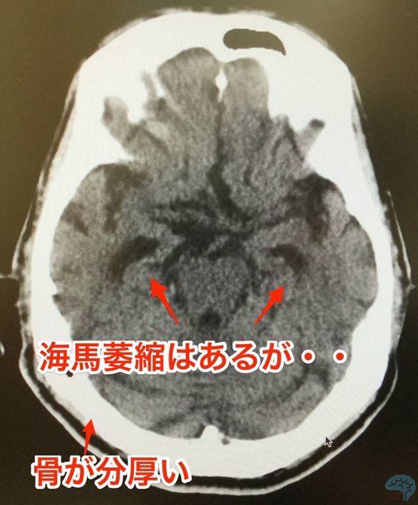 99歳の頭部CT