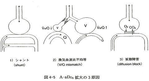 肺体血流比 計測 心エコー