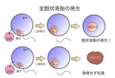 胎 胞状 ブログ 奇 侵入奇胎の闘病記