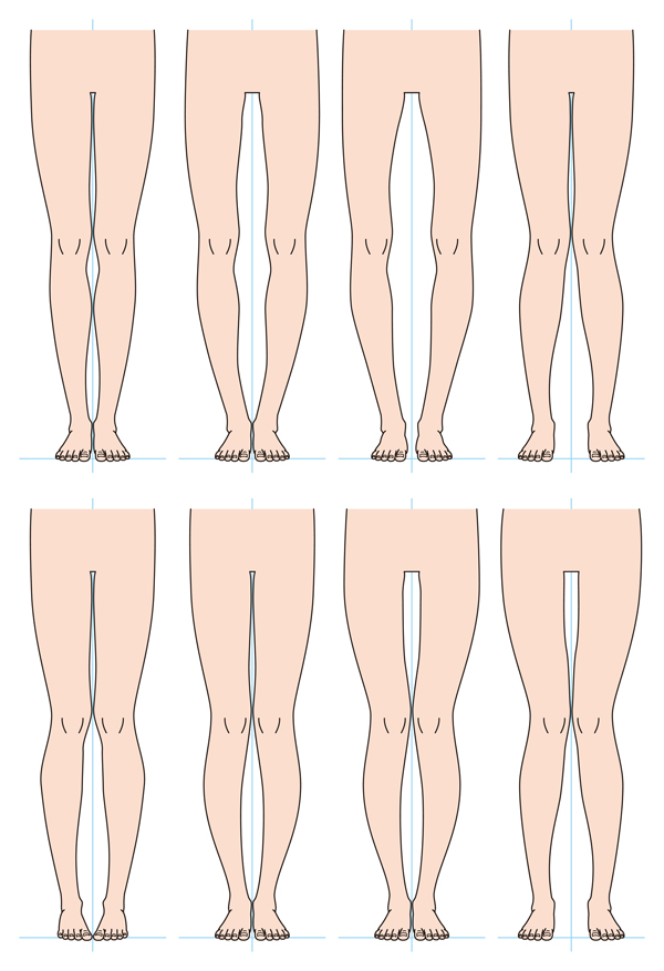 O脚とXO脚の違いとは?
