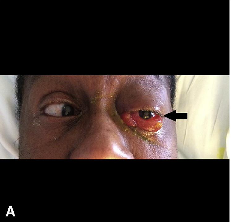 症例113 発熱と眼球突出がある71歳男性 J Emerg Med 17 Feb 52 2 E41 E43 りんごの街の救急医