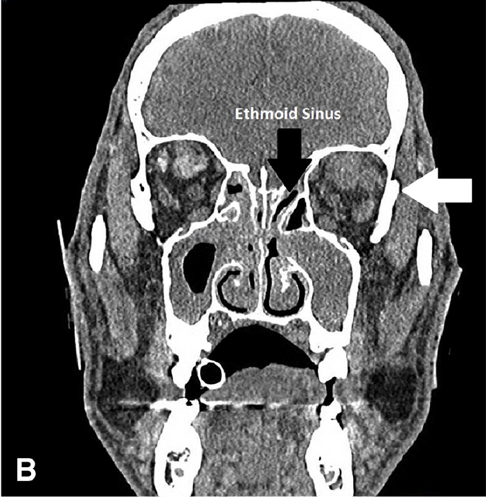 症例113 発熱と眼球突出がある71歳男性 J Emerg Med 17 Feb 52 2 E41 E43 りんごの街の救急医