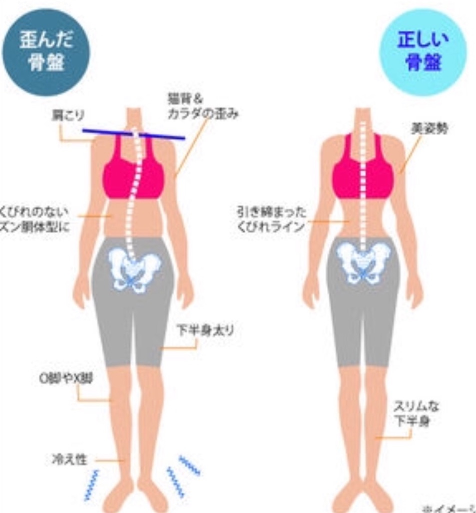 骨盤の歪み Applemintoの日記 骨盤の歪み Applemintoの日記
