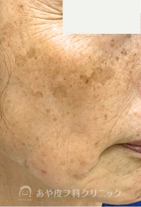 ガウディスキンでシミが改善した例①：レチノールとハイドロキノンの