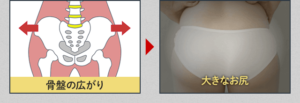ラルフィンガードルで骨盤の開きを矯正