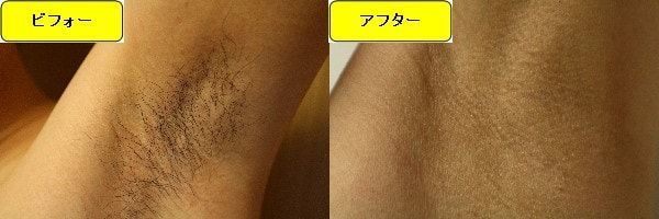 メンズ全身脱毛 ワキ毛 体験記 第３回目照射 比較画像 効果 値段 費用のご紹介 湘南美容クリニック 男 ヒゲ脱毛通信