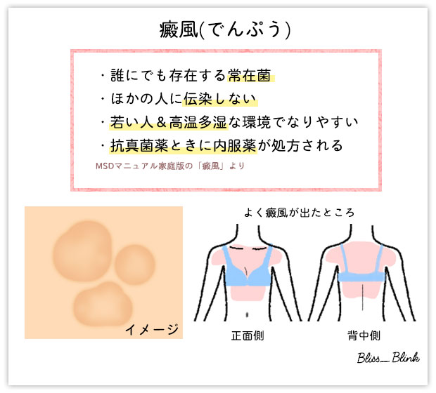 癜風(でんぷう)って知っていますか？もし医師から癜風だと言われたら 