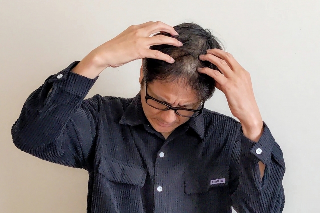 薄毛の悩みで頭抱えている中年男性