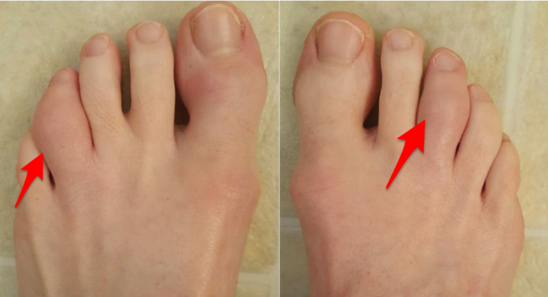 変形性関節症の初期症状