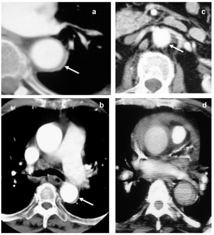 巨細胞性動脈炎と大動脈炎:レビュー 膠原病・リウマチ一人抄読会