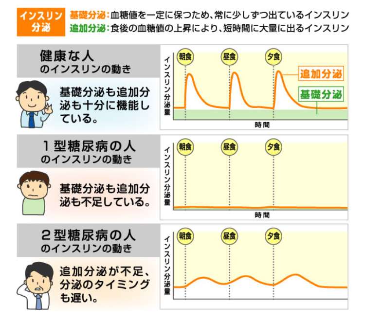 1型糖尿病とは 結構簡単に死ぬ病気 です アメリカ 1型糖尿病 観察記