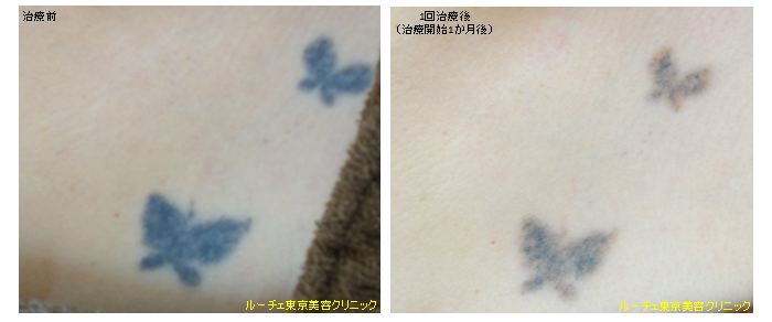 f:id:DrLUCE:20170123161905p:plain