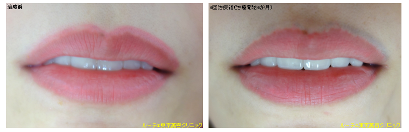 f:id:DrLUCE:20170710195025p:plain f:id:DrLUCE:20170710195025p:plain