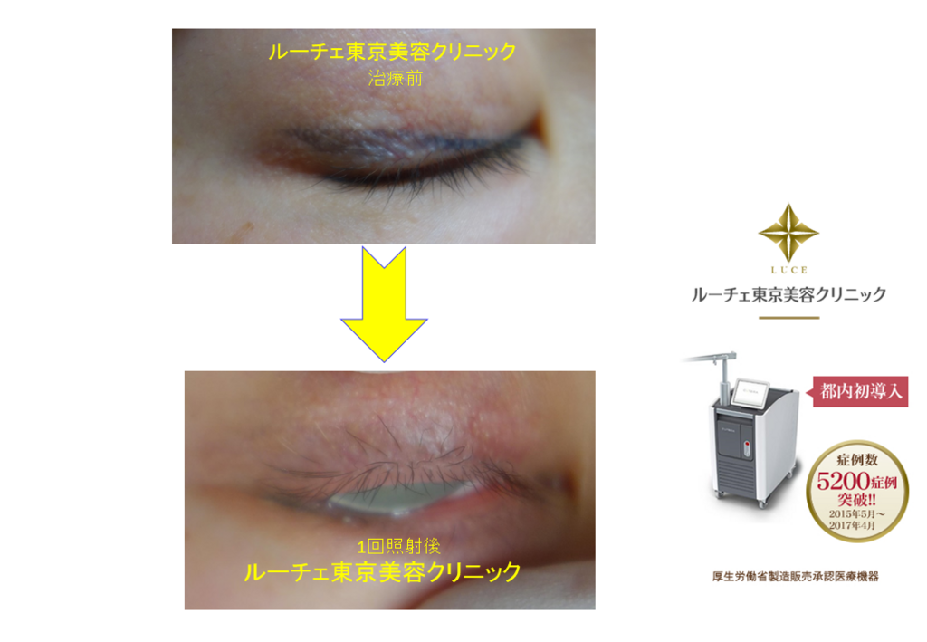 f:id:DrLUCE:20171113190345p:plain f:id:DrLUCE:20171113190345p:plain