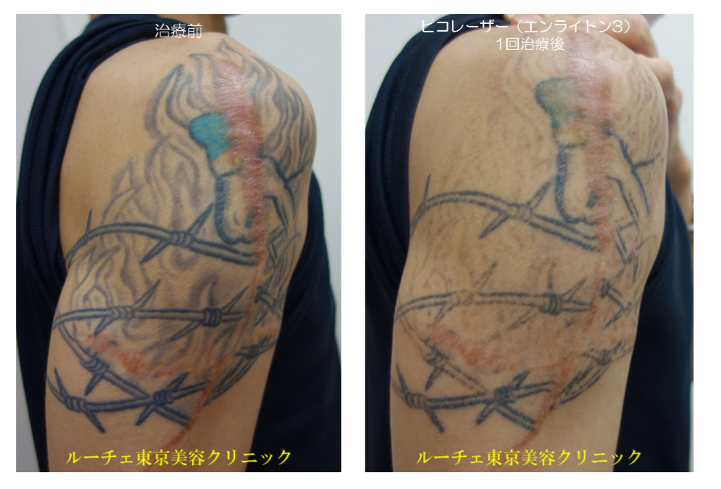 f:id:DrLUCE:20171213192101p:plain f:id:DrLUCE:20171213192101p:plain