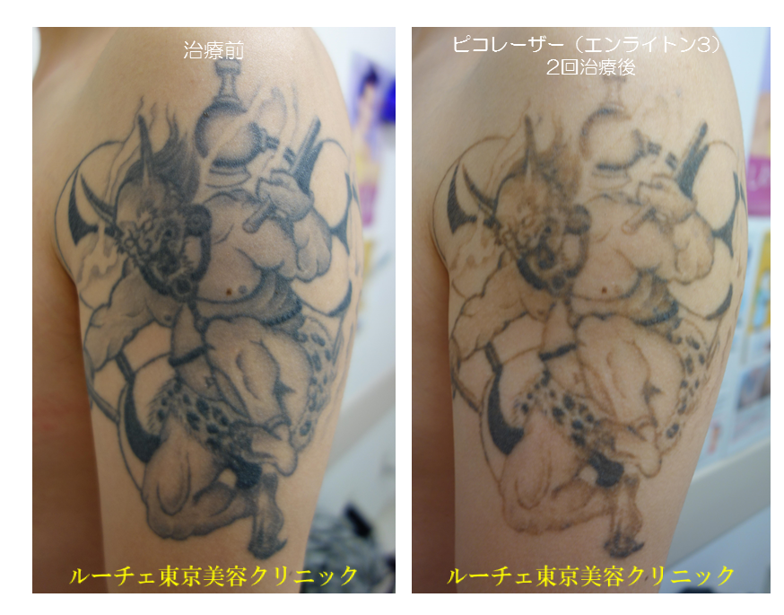 f:id:DrLUCE:20171219121342p:plain ルーチェ美容クリニック171221ピコレーザータトゥー消すビフォーアフター