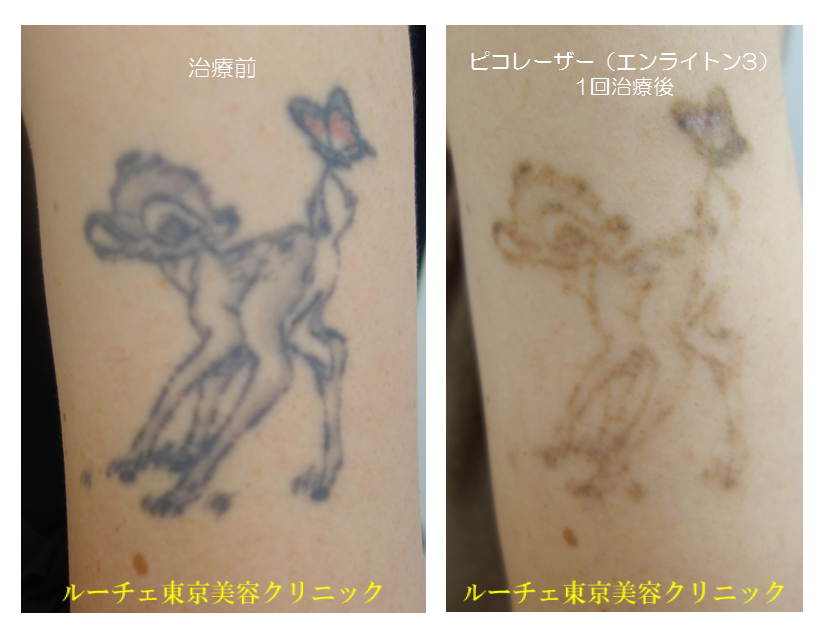 f:id:DrLUCE:20171220115412p:plain ルーチェ美容クリニック171229ピコレーザータトゥー消すビフォーアフター