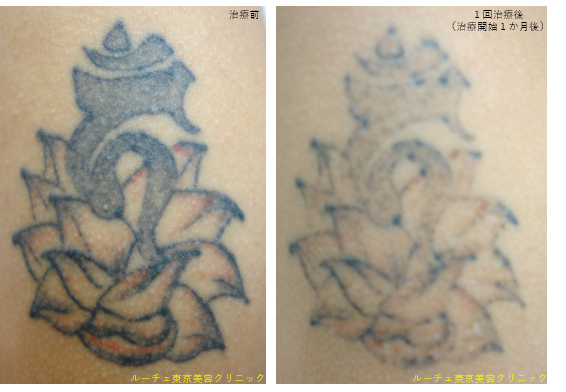 ルーチェ東京美容クリニックピコレーザータトゥー消す症例