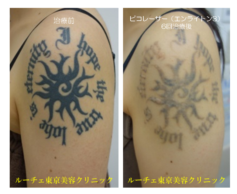 f:id:DrLUCE:20180124134538p:plain f:id:DrLUCE:20180124134538p:plain