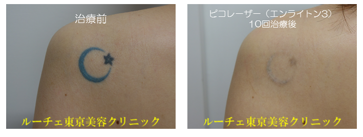 f:id:DrLUCE:20180303095331p:plain f:id:DrLUCE:20180303095331p:plain