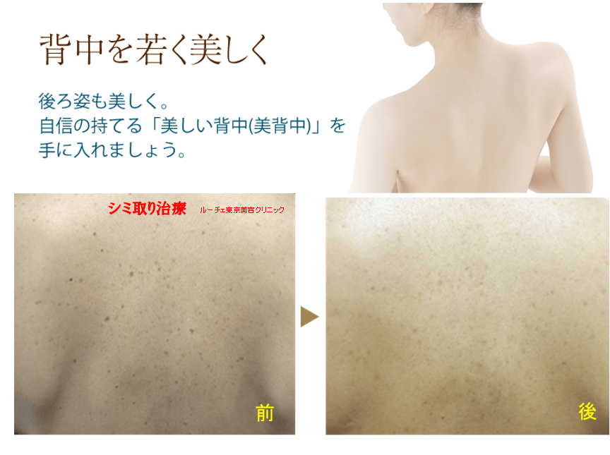 背中のシミ取り~美背中ケア~ - ルーチェ東京美容クリニック美容治療症例ブログ