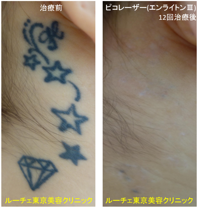 f:id:DrLUCE:20180703143207p:plain f:id:DrLUCE:20180703143207p:plain