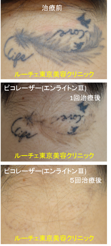 f:id:DrLUCE:20180715113522p:plain f:id:DrLUCE:20180715113522p:plain