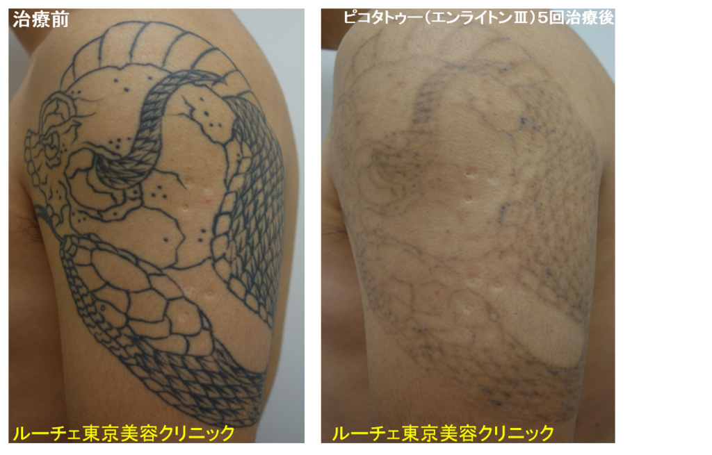 f:id:DrLUCE:20180902174521p:plain f:id:DrLUCE:20180902174521p:plain