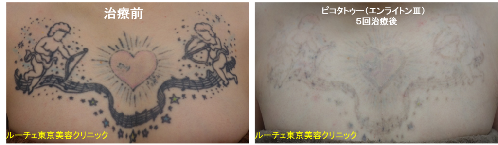 f:id:DrLUCE:20180906121900p:plain f:id:DrLUCE:20180906121900p:plain