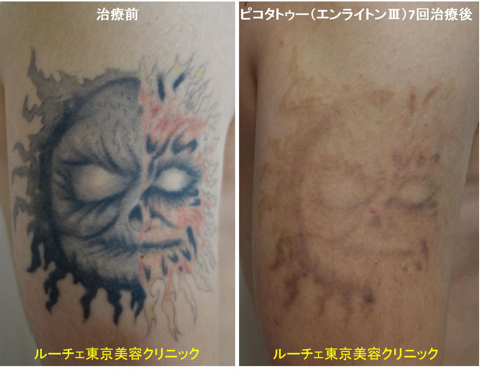 f:id:DrLUCE:20180918153555p:plain