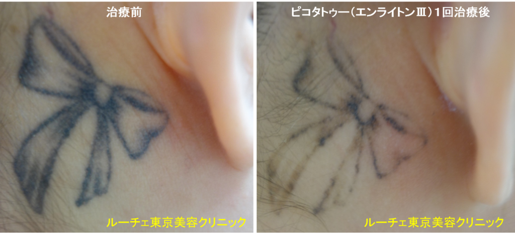 f:id:DrLUCE:20180929111253p:plain f:id:DrLUCE:20180929111253p:plain