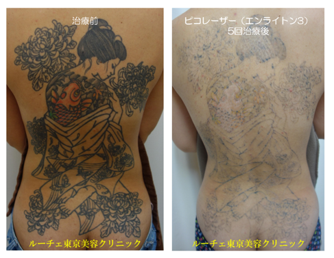 ピコレーザータトゥー除去大きいタトゥー@ルーチェ東京美容クリニック