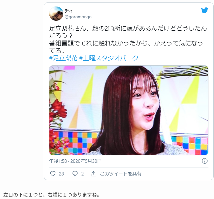 足立 梨花 顔 の アザ - ♥足立梨花の顔のアザの原因は?シミ取り 