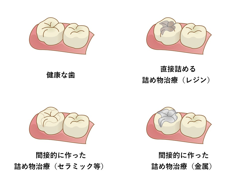 f:id:Fukumen-Dentist:20190313024342j:plain