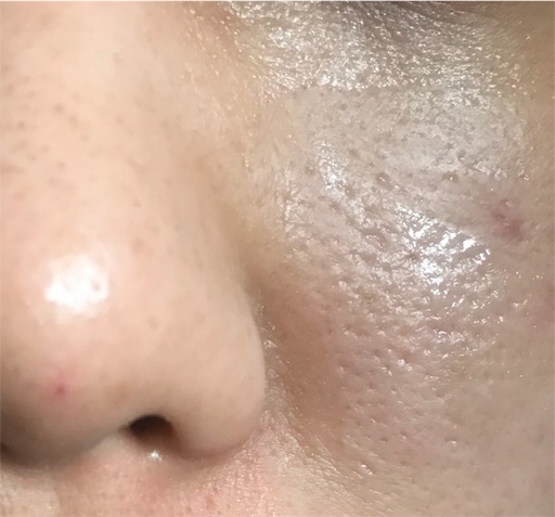 16歩目 小鼻の横の毛穴 その後 美肌を目指して歩き続ける