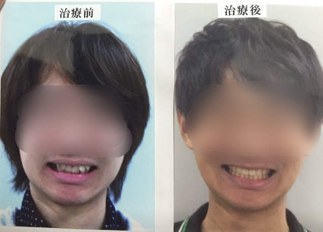 f:id:IMURUTA:20180825123523j:plain 歯列矯正のビフォーアフター