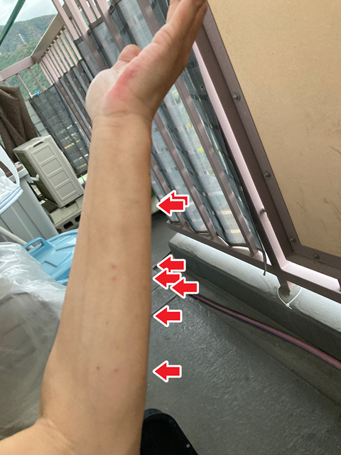 左腕だけで10か所近く蚊に刺されたッ!!
