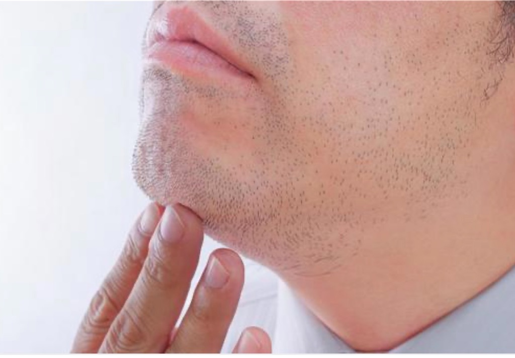 髭濃い男の毛を薄くする方法 ゆーくん