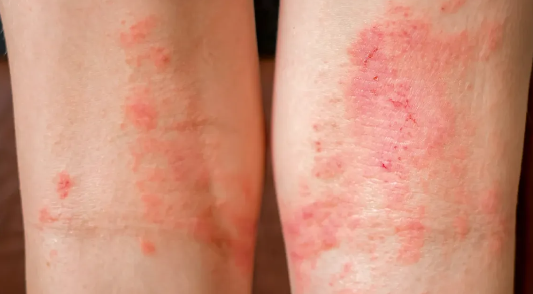 アレルギー性皮膚炎は、主としてアトピー性皮膚炎と接触性皮膚炎に分類
