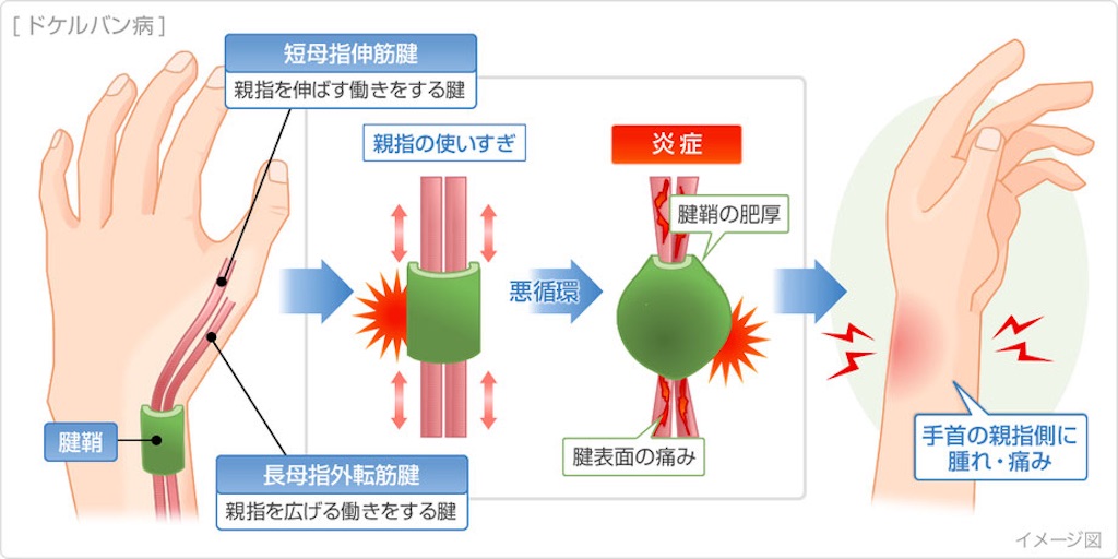 腱鞘炎の原因と治し方を理解する