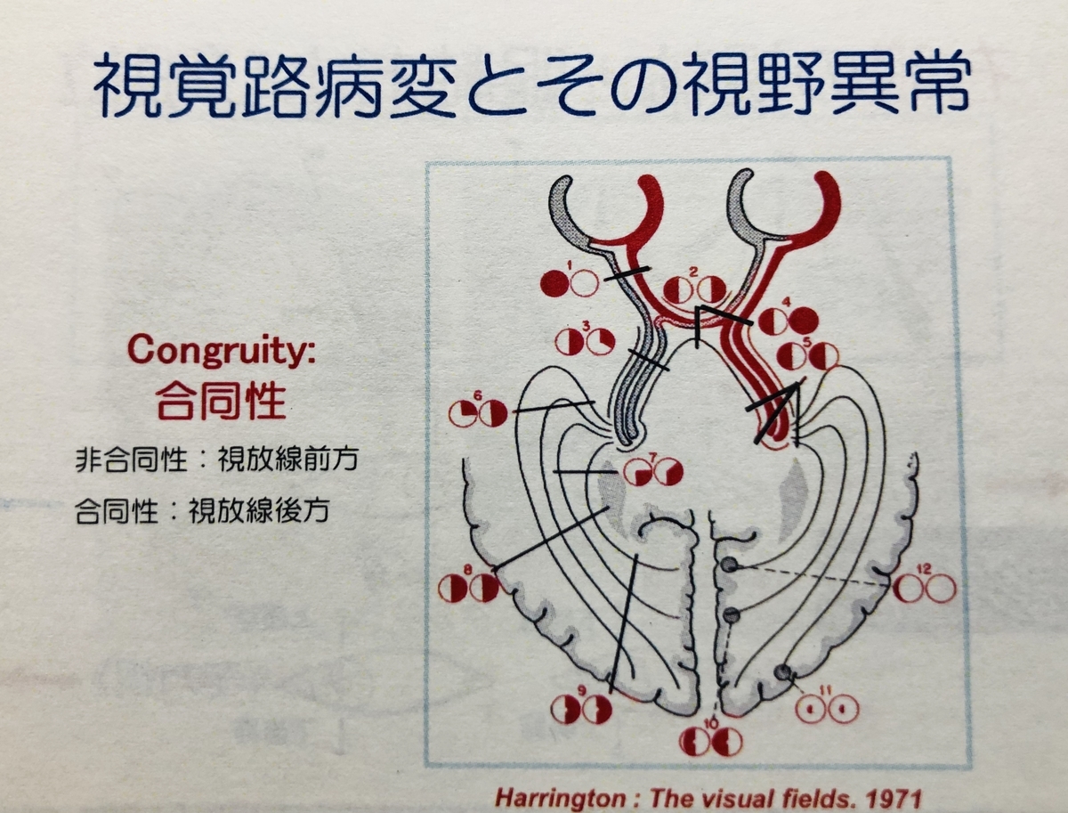 廣瀬源二郎先生の神経内科レクチャーまとめ 南砺の病院家庭医が勉強記録を始めました An Archive Of Medical Articles Summarized By A Family Physician From Nanto Municipal Hospital 廣瀬源二郎先生の神経内科レクチャーまとめ 南砺の病院家庭医が勉強記録を始めました An Archive Of Medical Articles Summarized By A Family Physician From Nanto Municipal Hospital