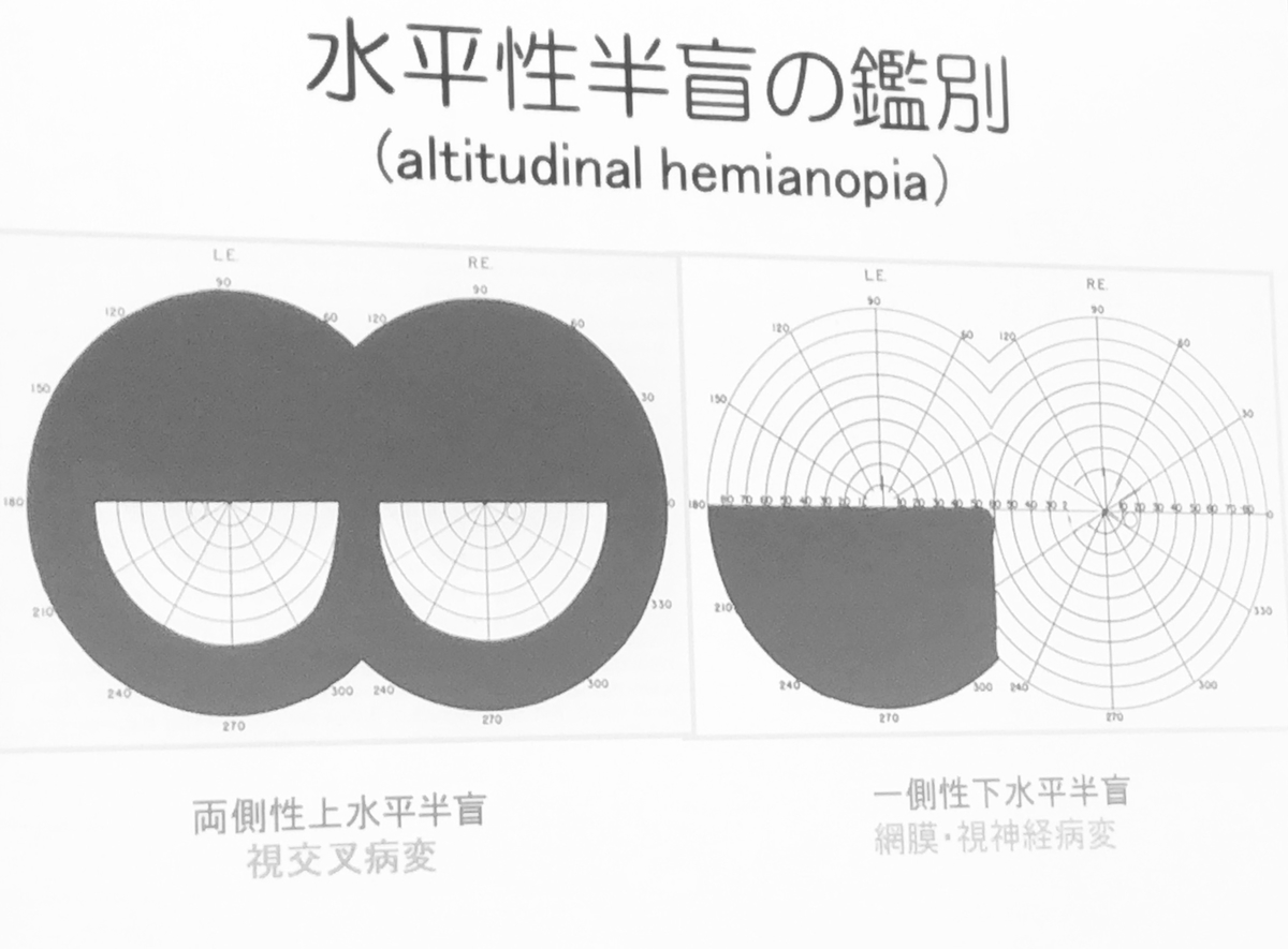 廣瀬源二郎先生の神経内科レクチャーまとめ 南砺の病院家庭医が勉強記録を始めました An Archive Of Medical Articles Summarized By A Family Physician From Nanto Municipal Hospital 廣瀬源二郎先生の神経内科レクチャーまとめ 南砺の病院家庭医が勉強記録を始めました An Archive Of Medical Articles Summarized By A Family Physician From Nanto Municipal Hospital