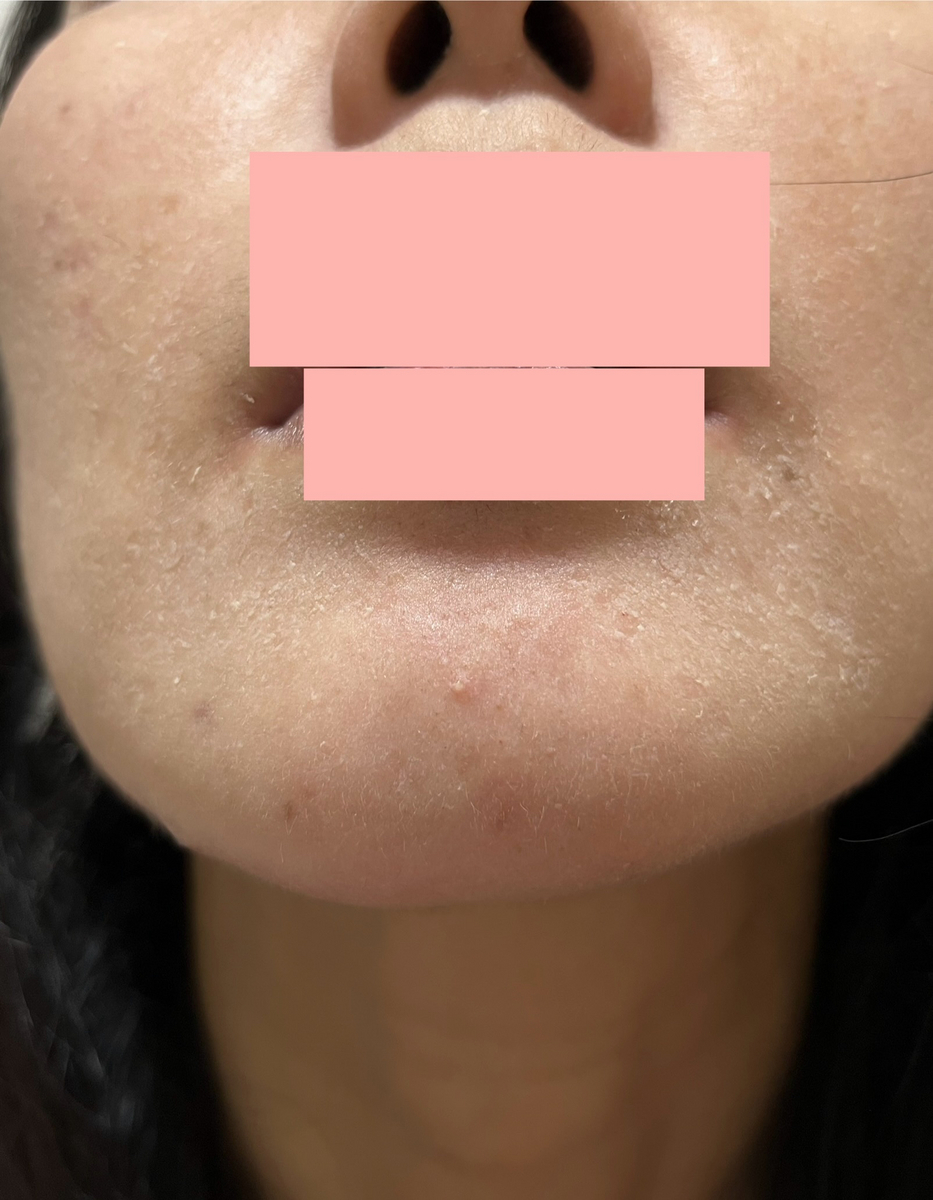 ゼオスキン  ニキビたくさんできる　効果　