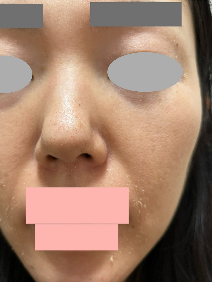 鼻の角栓　ザラザラ　取れる　ゼオスキン 