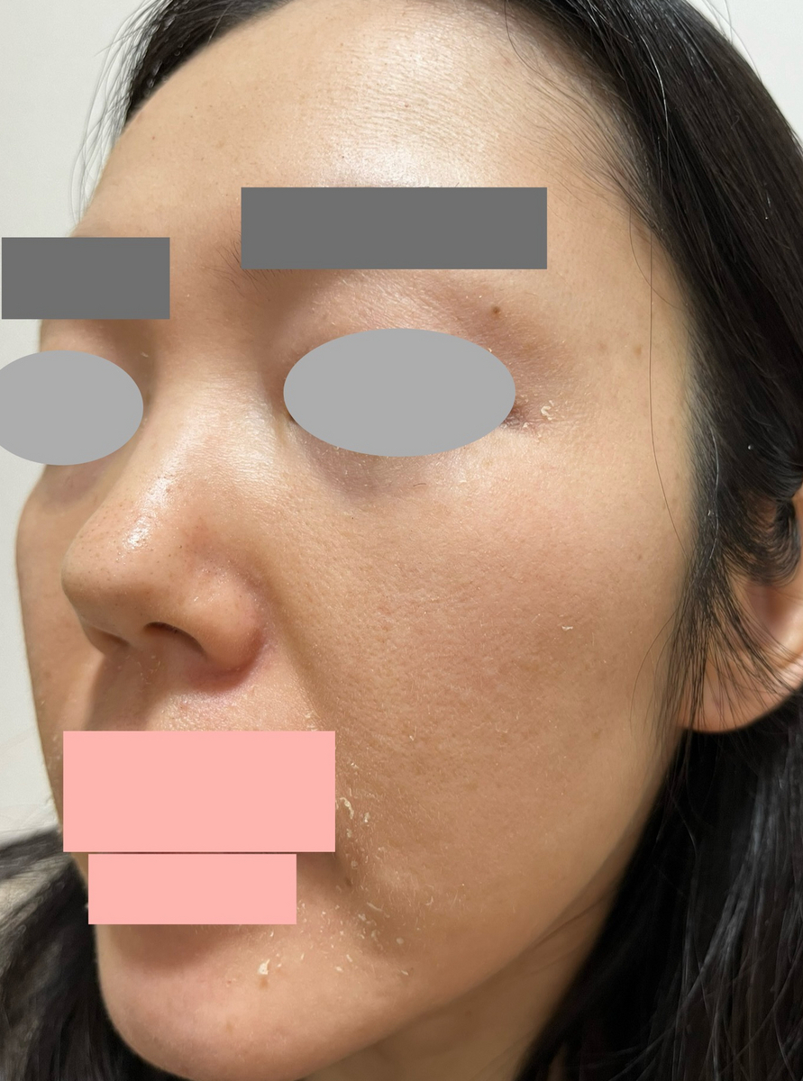 セラピューティック　経過　肌綺麗　ブログ