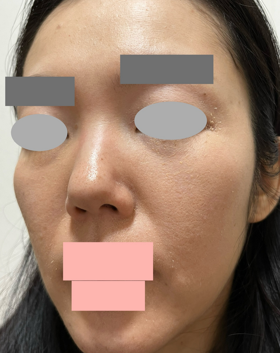 セラピューティック中　メイク　皮剥け