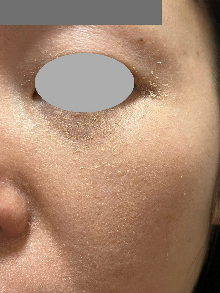 ゼオスキン  メイク浮く　皮剥け