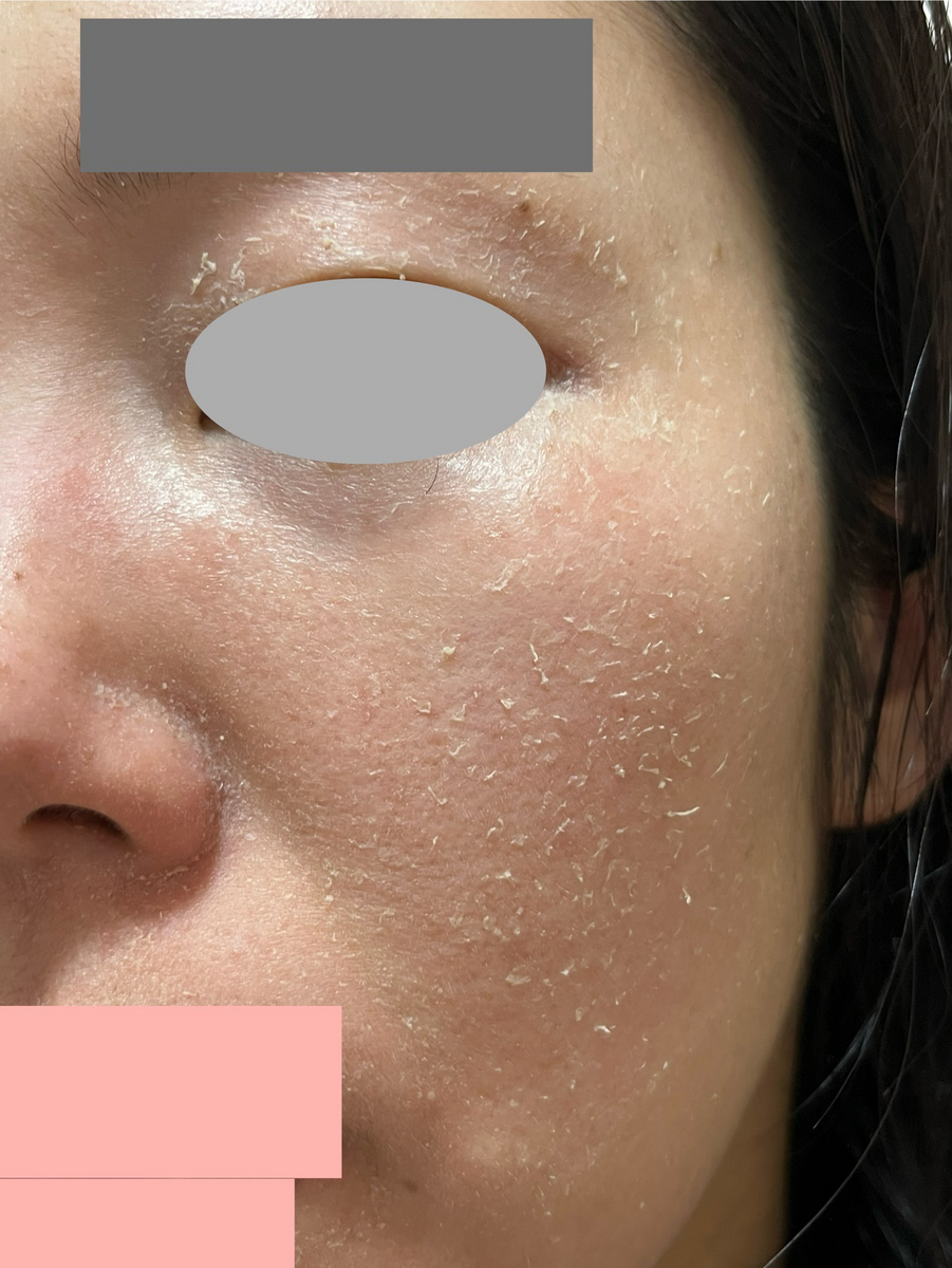 セラピューティック　メイク後　皮剥けひどい